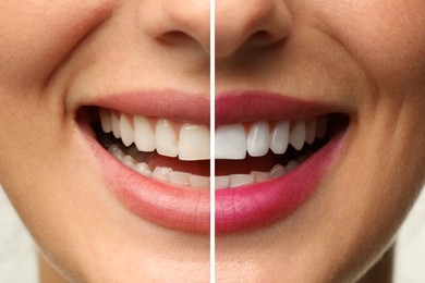 Image of Woman smiling before and after procedure dental veneers placement, closeup. Aesthetic improvement of teeth, collage