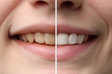 Image of Woman smiling before and after procedure dental veneers placement, closeup. Aesthetic improvement of teeth, collage