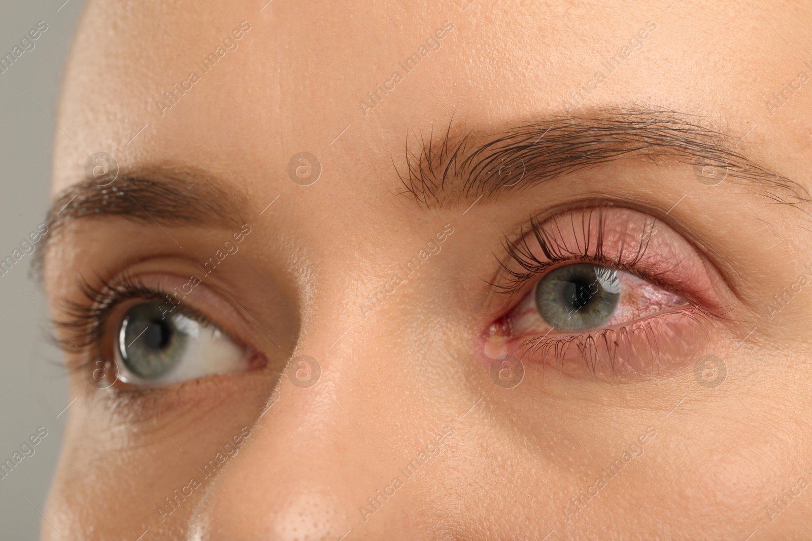 Image of Conjunctivitis. Young woman with infected eye, closeup