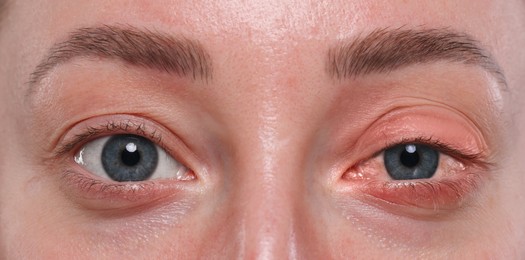 Image of Conjunctivitis. Young woman with bloodshot in eye, closeup