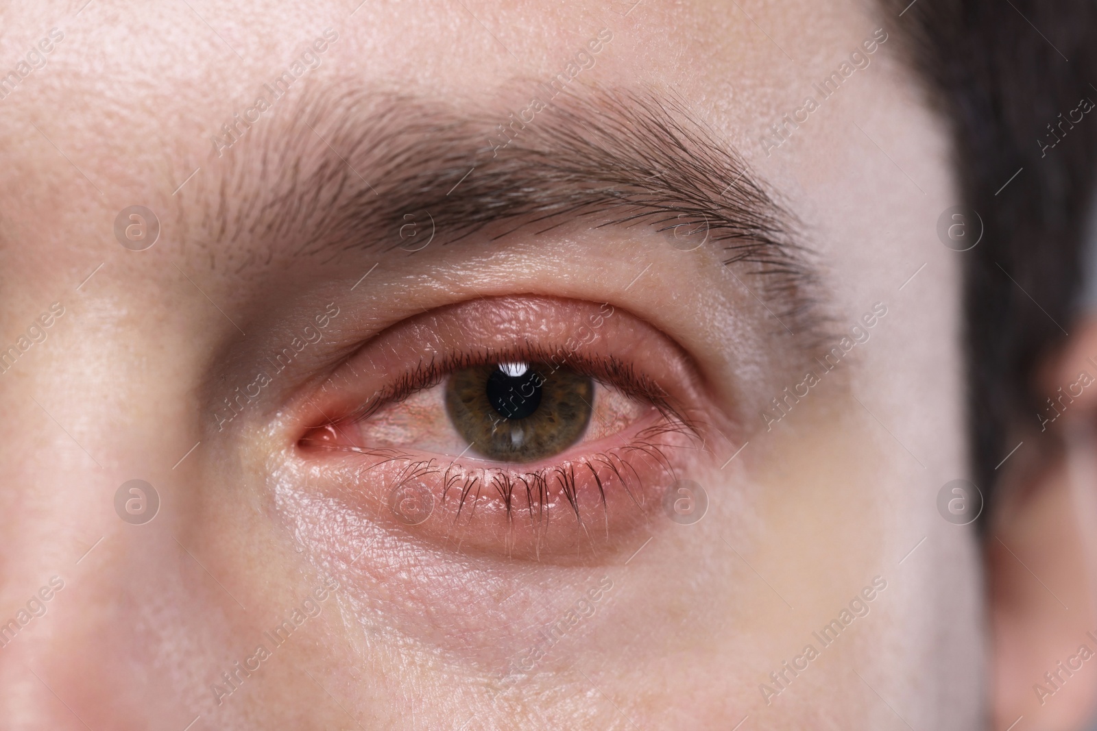 Image of Conjunctivitis. Man with bloodshot in eye, closeup