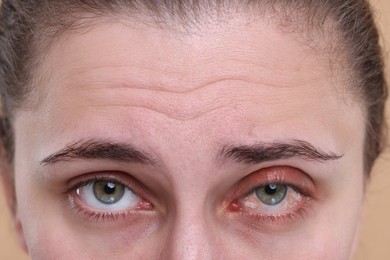 Image of Conjunctivitis. Young woman with bloodshot in eye, closeup