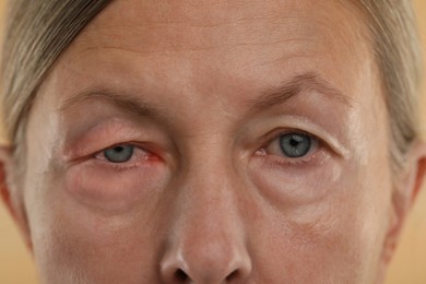 Image of Conjunctivitis. Senior woman with bloodshot in eye, closeup