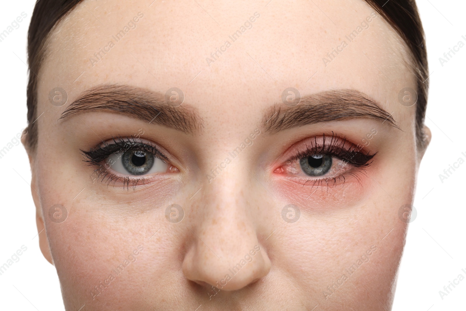 Image of Conjunctivitis. Young woman with bloodshot in eye on white background, closeup