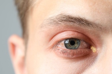 Image of Conjunctivitis. Young man with infected eye, closeup