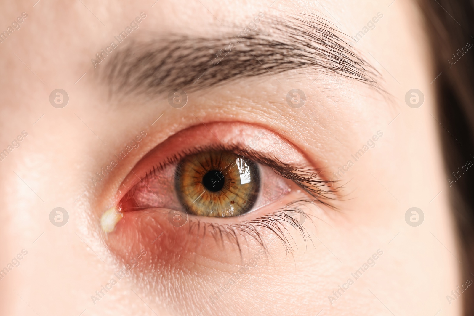 Image of Conjunctivitis. Young woman with infected eye, closeup