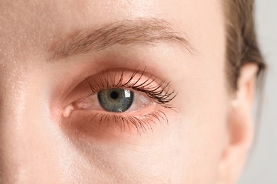 Image of Conjunctivitis. Young woman with infected eye, closeup