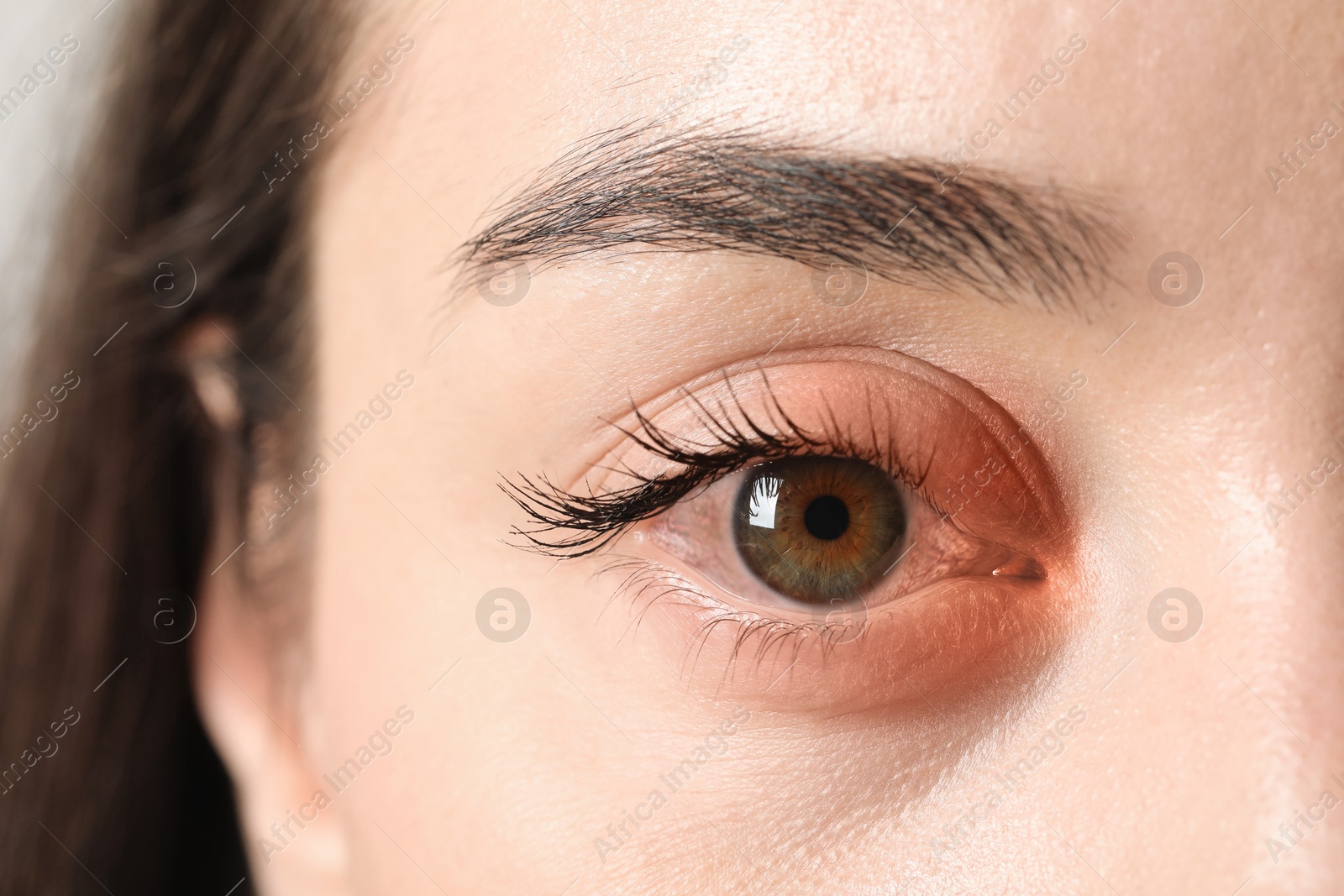 Image of Conjunctivitis. Young woman with infected eye, closeup