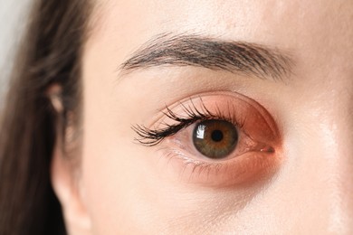 Image of Conjunctivitis. Young woman with infected eye, closeup