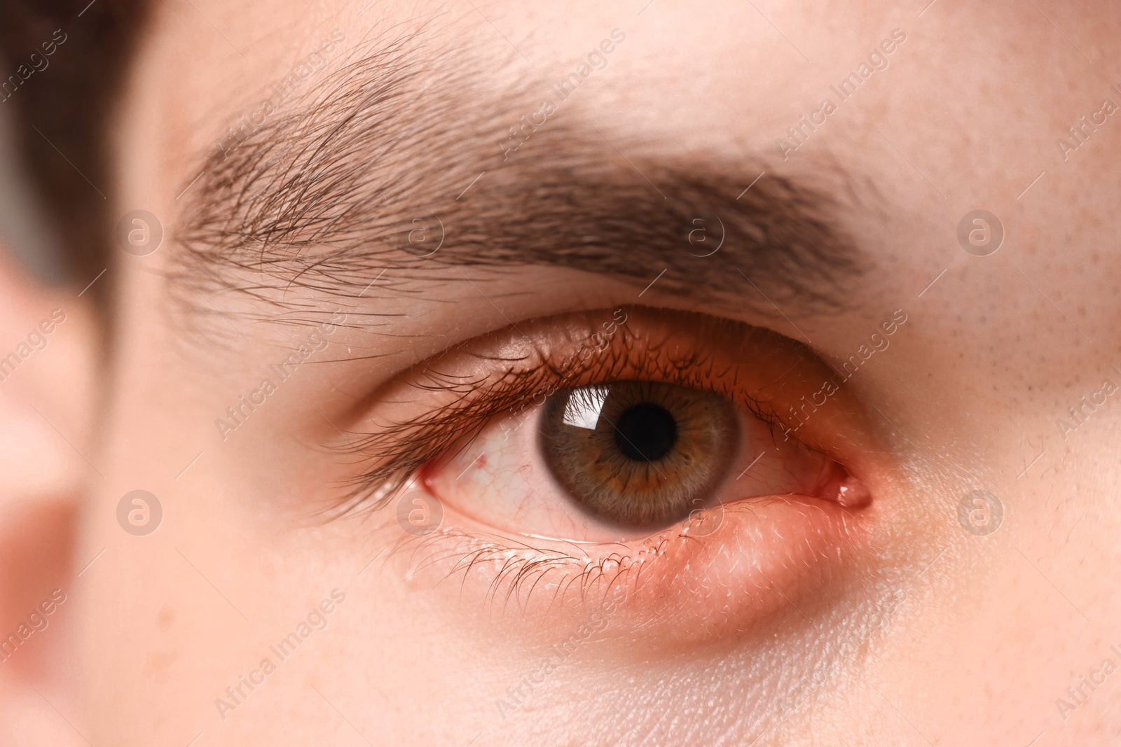 Image of Conjunctivitis. Young man with infected eye, closeup