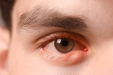 Image of Conjunctivitis. Young man with infected eye, closeup