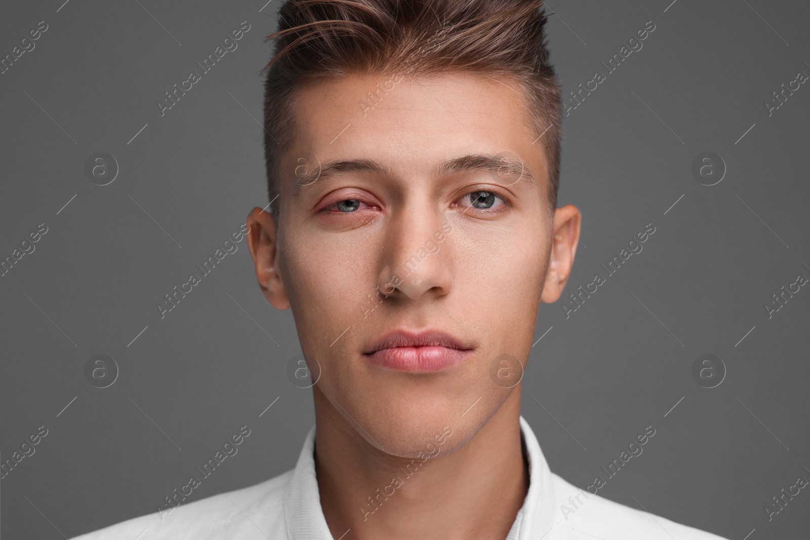 Image of Conjunctivitis. Young man with red eye on grey background