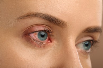 Image of Conjunctivitis. Young woman with bloodshot in eye, closeup