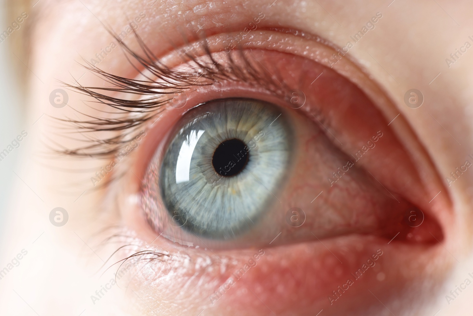 Image of Conjunctivitis. Young woman with bloodshot in eye, closeup