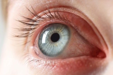 Image of Conjunctivitis. Young woman with bloodshot in eye, closeup