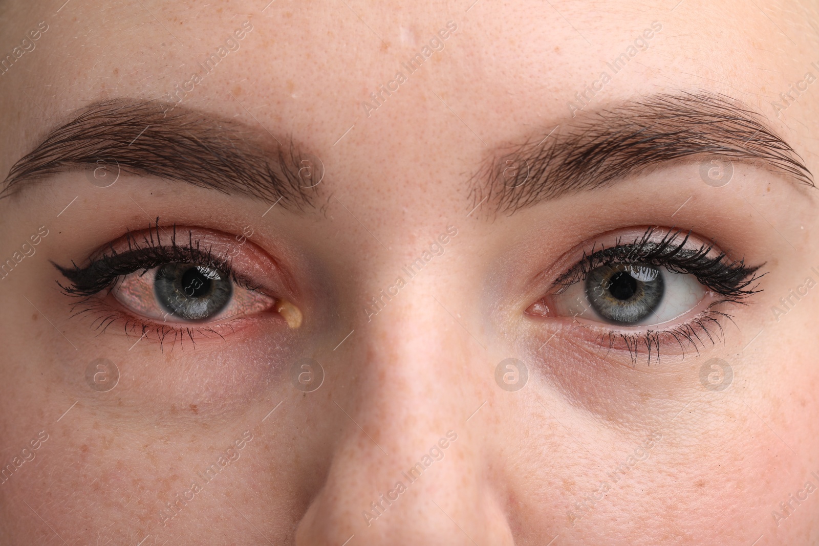 Image of Conjunctivitis. Young woman with infected eye, closeup