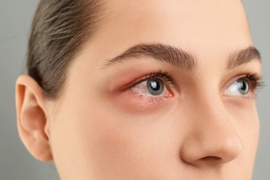 Image of Conjunctivitis. Young woman with bloodshot in eye on grey background, closeup