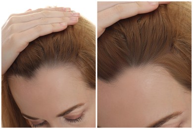 Image of Woman with hair loss problem before and after treatment on white background, closeup. Collage of photos