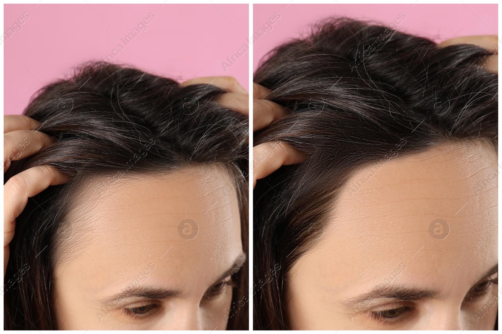 Image of Woman with hair loss problem before and after treatment on pink background, closeup. Collage of photos