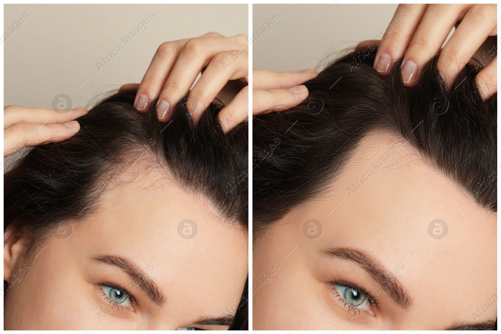 Image of Woman with hair loss problem before and after treatment on grey background, closeup. Collage of photos