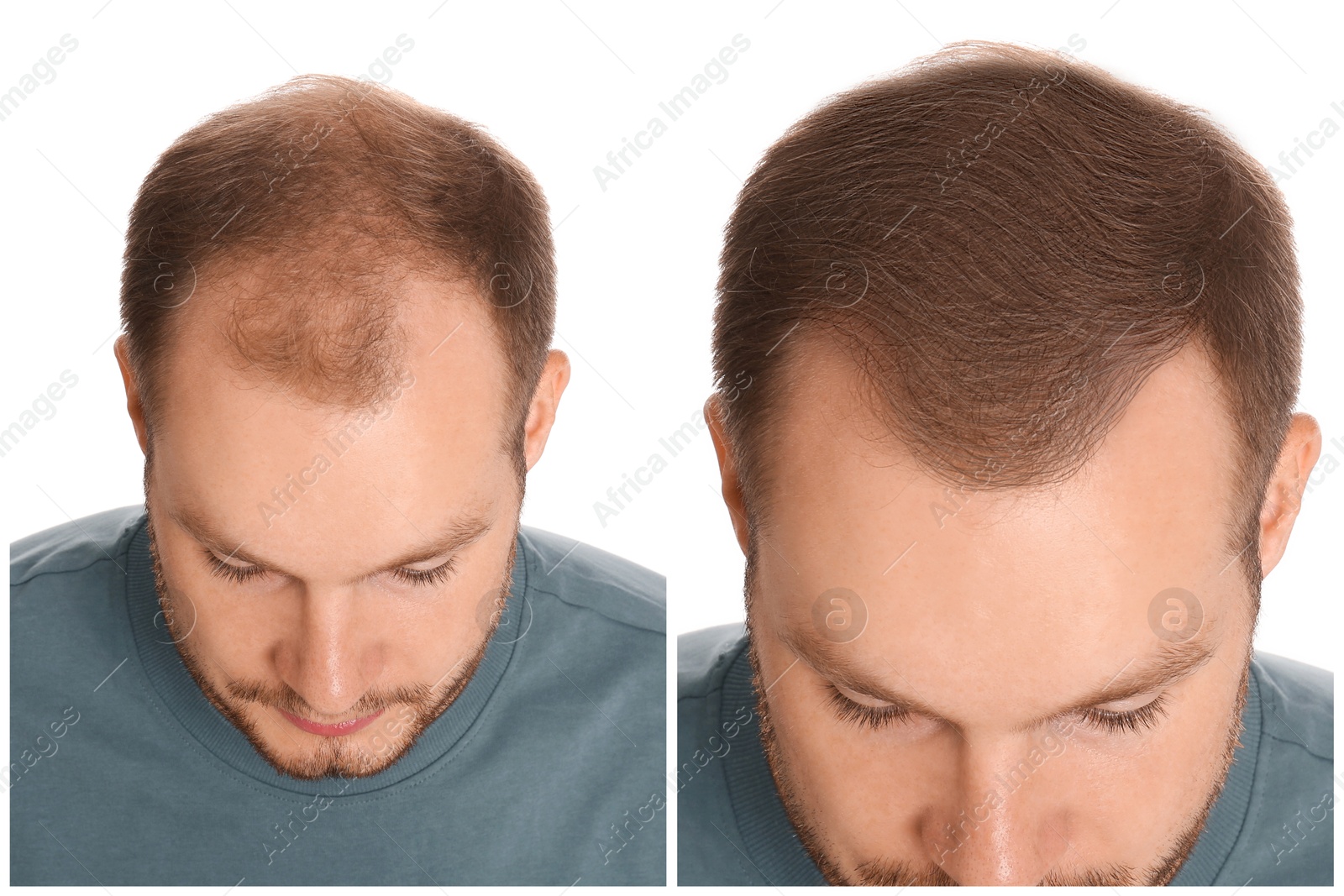 Image of Man with hair loss problem before and after treatment on white background. Collage of photos