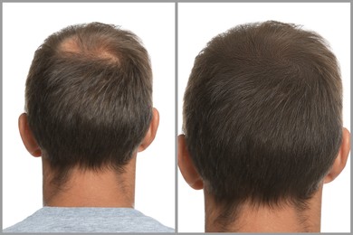 Image of Man with hair loss problem before and after treatment on white background, back view. Collage of photos