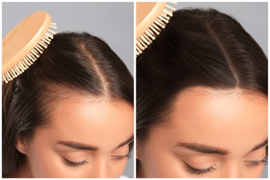 Image of Young woman with hair loss problem before and after treatment on grey background, closeup. Collage of photos