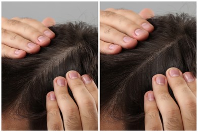 Image of Man with hair loss problem before and after treatment on grey background, closeup. Collage of photos