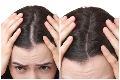 Image of Young woman with hair loss problem before and after treatment on white background, closeup. Collage of photos