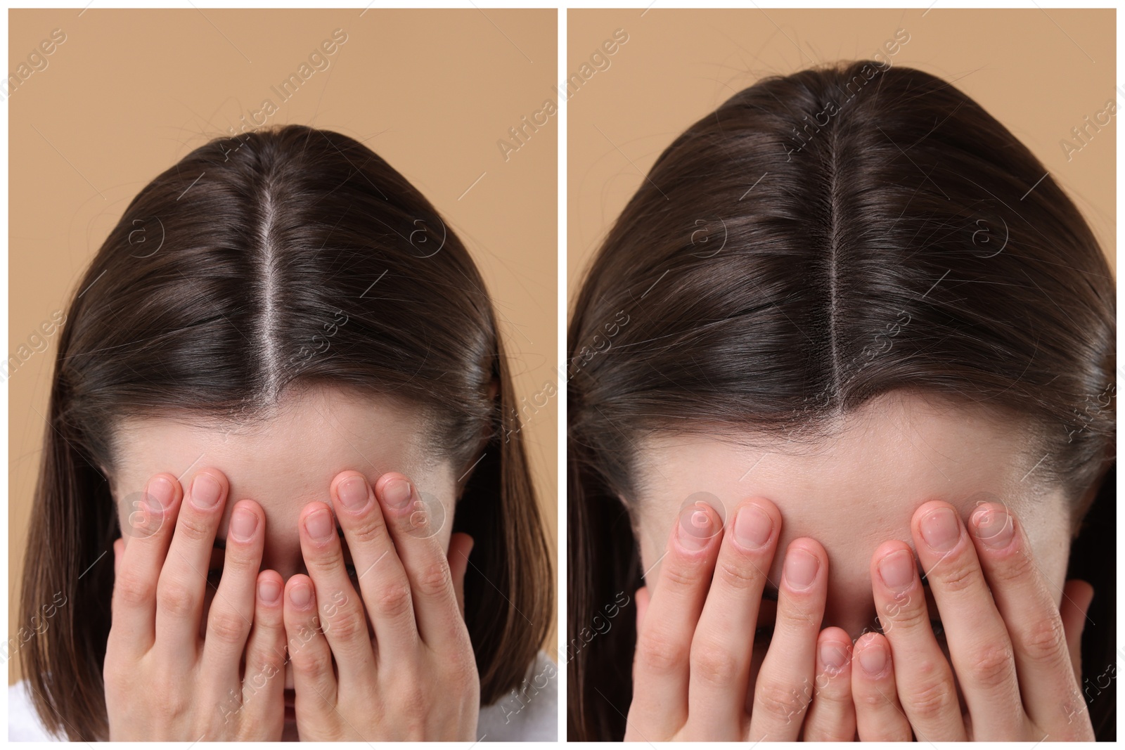 Image of Woman suffering from hair loss problem on dark beige background, closeup. Collage with photos before and after treatment