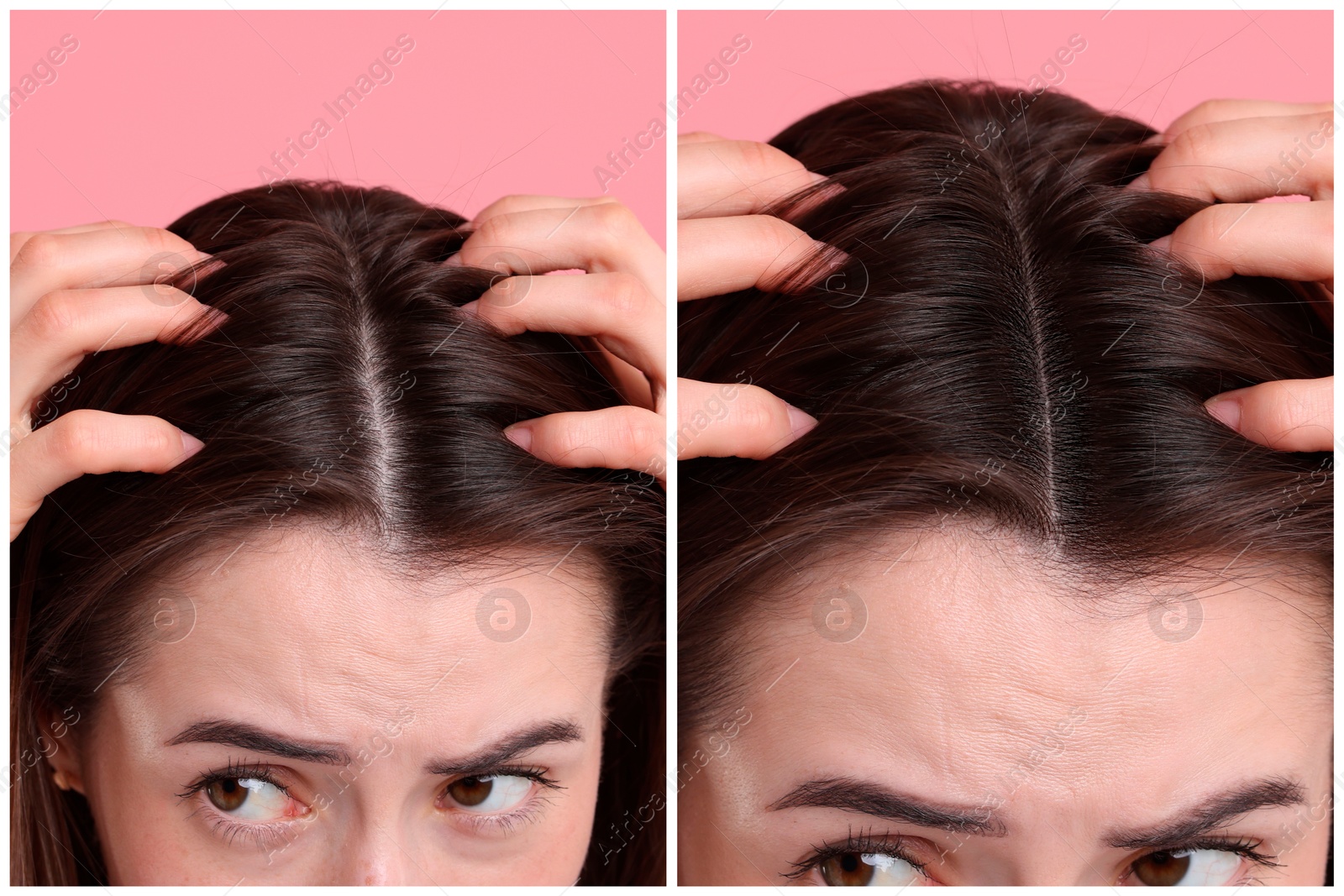 Image of Young woman suffering from hair loss problem on pink background, closeup. Collage with photos before and after treatment