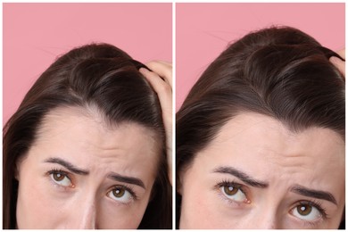 Image of Young woman suffering from hair loss problem on pink background, closeup. Collage with photos before and after treatment