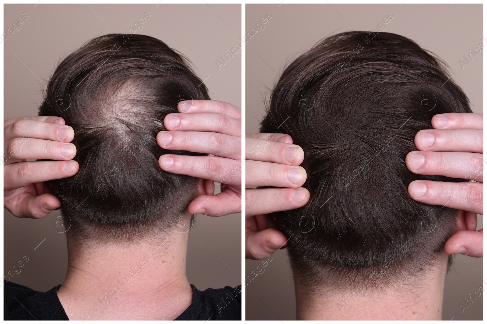 Image of Man with hair loss problem before and after treatment on grey background, back view. Collage of photos