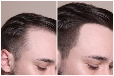 Image of Man with hair loss problem before and after treatment on grey background, closeup. Collage of photos