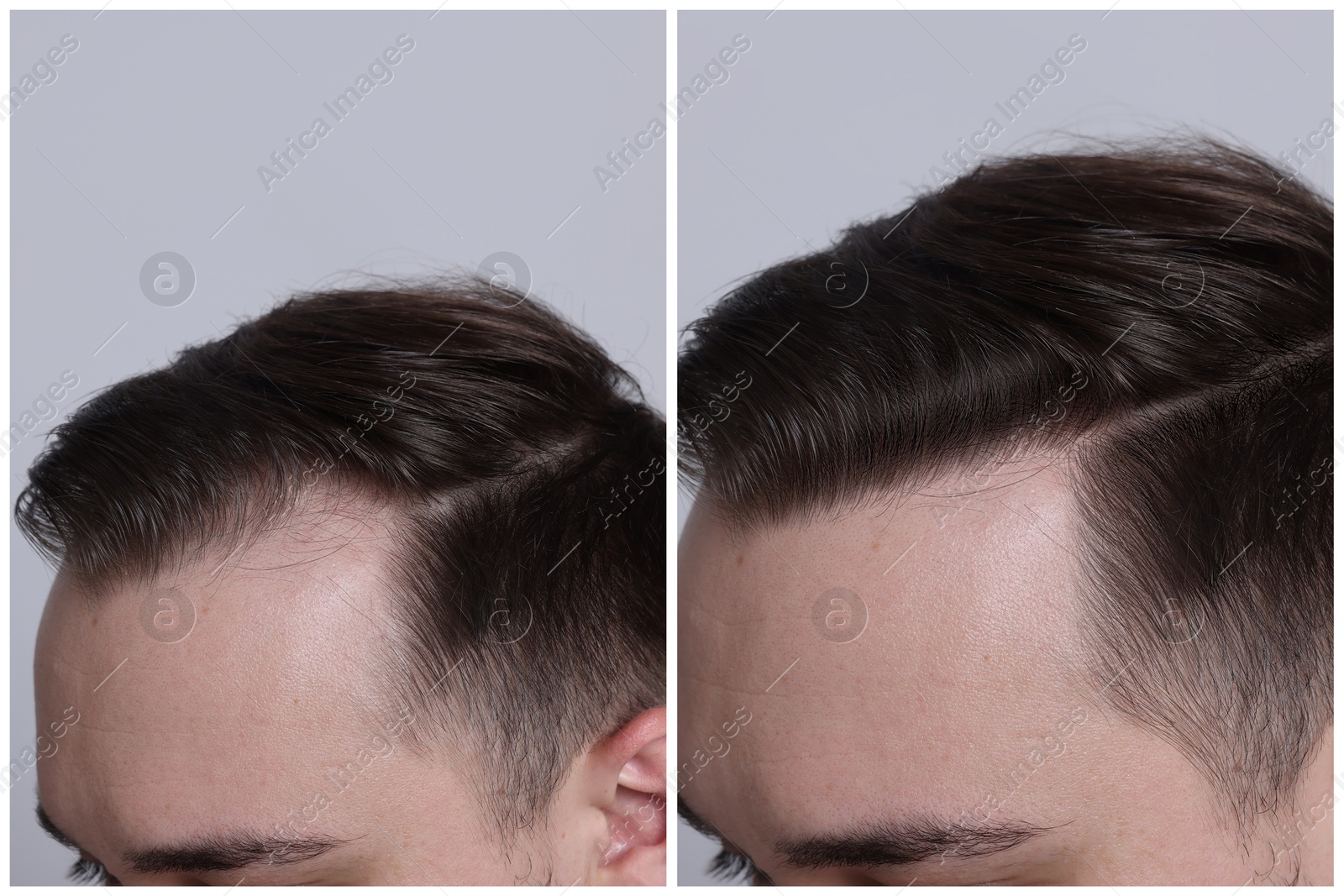 Image of Man with hair loss problem before and after treatment on light grey background, closeup. Collage of photos