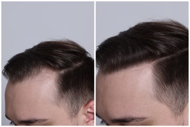 Image of Man with hair loss problem before and after treatment on light grey background, closeup. Collage of photos