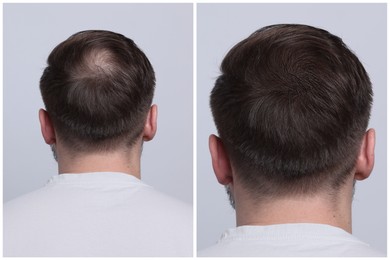 Image of Man with hair loss problem before and after treatment on light grey background, back view. Collage of photos