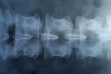 Photo of X-ray image of spinal column as background, closeup