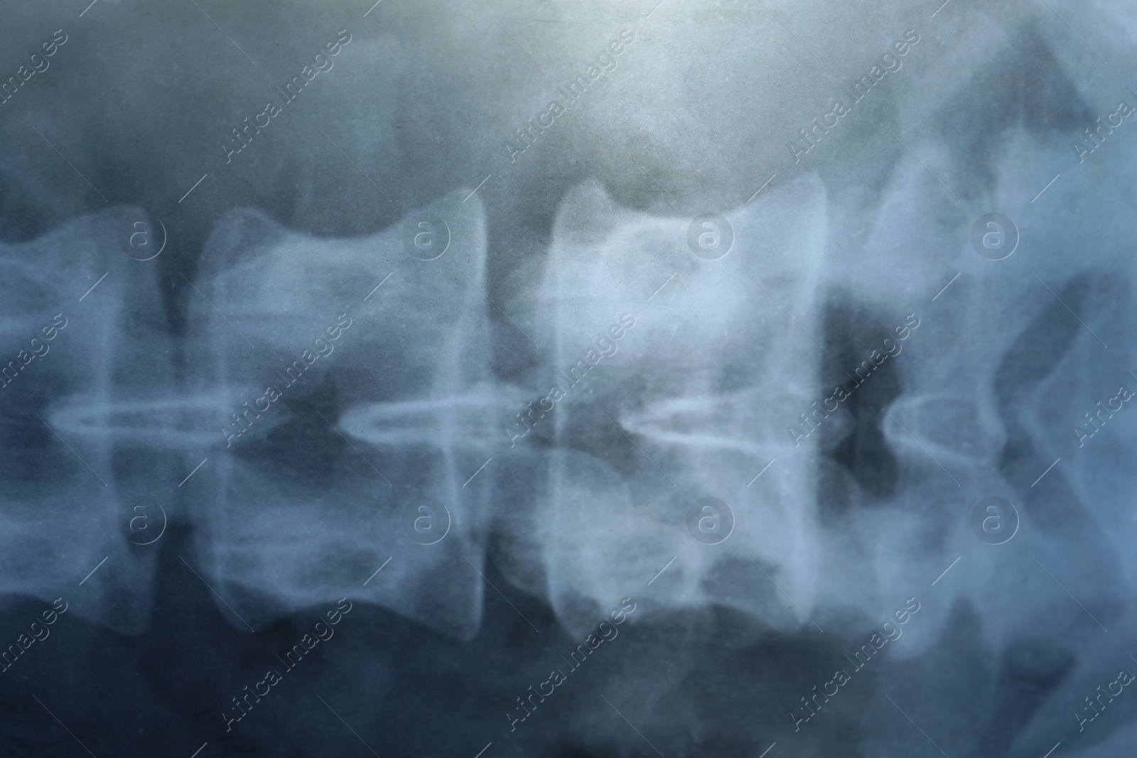 Photo of X-ray image of spinal column as background, closeup