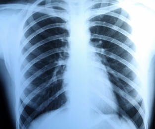 Photo of X-ray image of ribcage as background, closeup