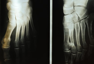 Photo of X-ray image of human foot, closeup view