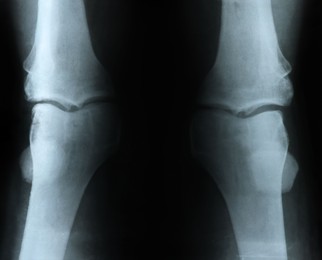 Photo of X-ray image of knee joint on white background