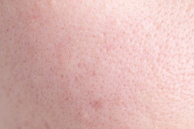 Photo of Texture of skin with enlarged pores as background, closeup