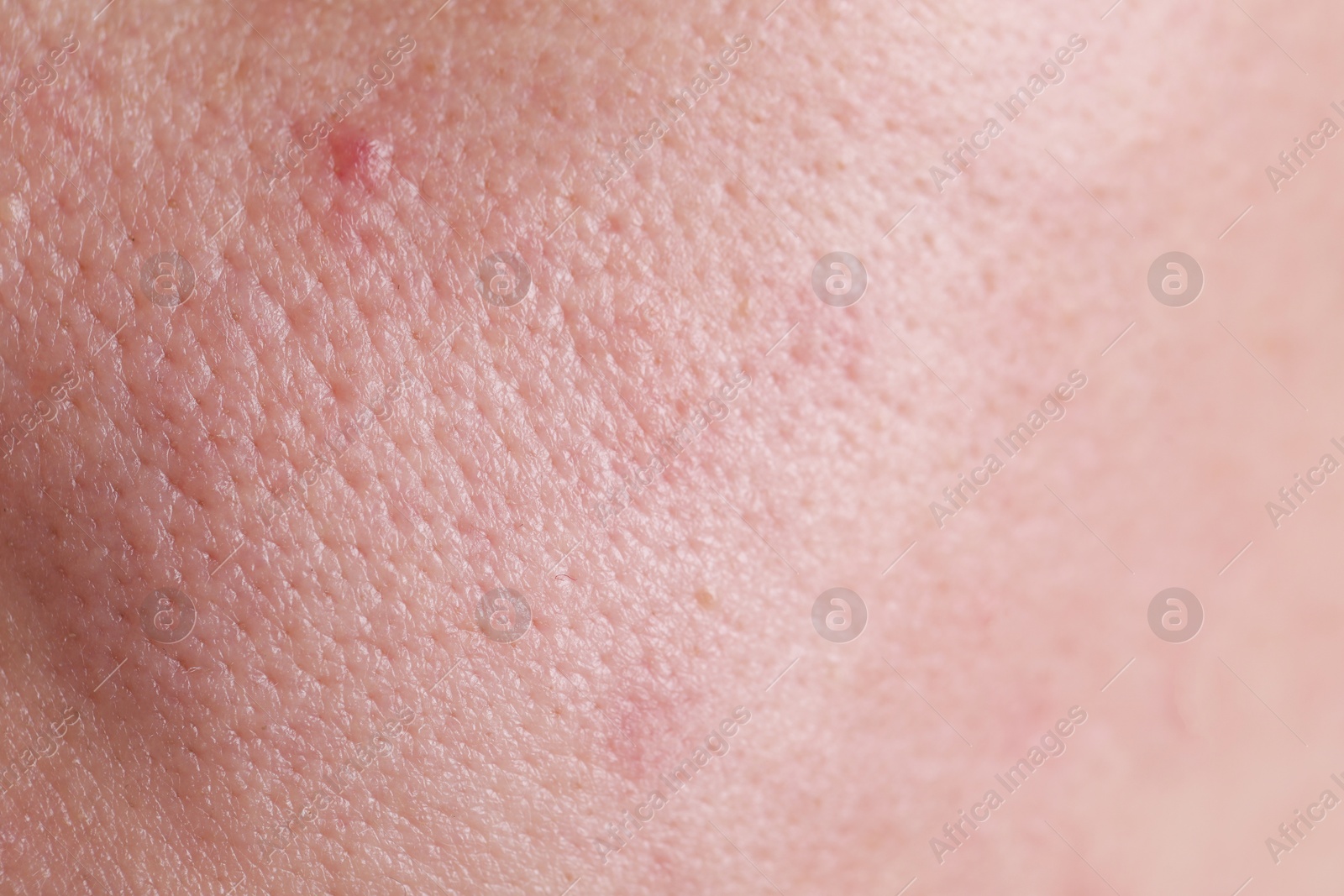 Photo of Texture of skin with enlarged pores as background, closeup