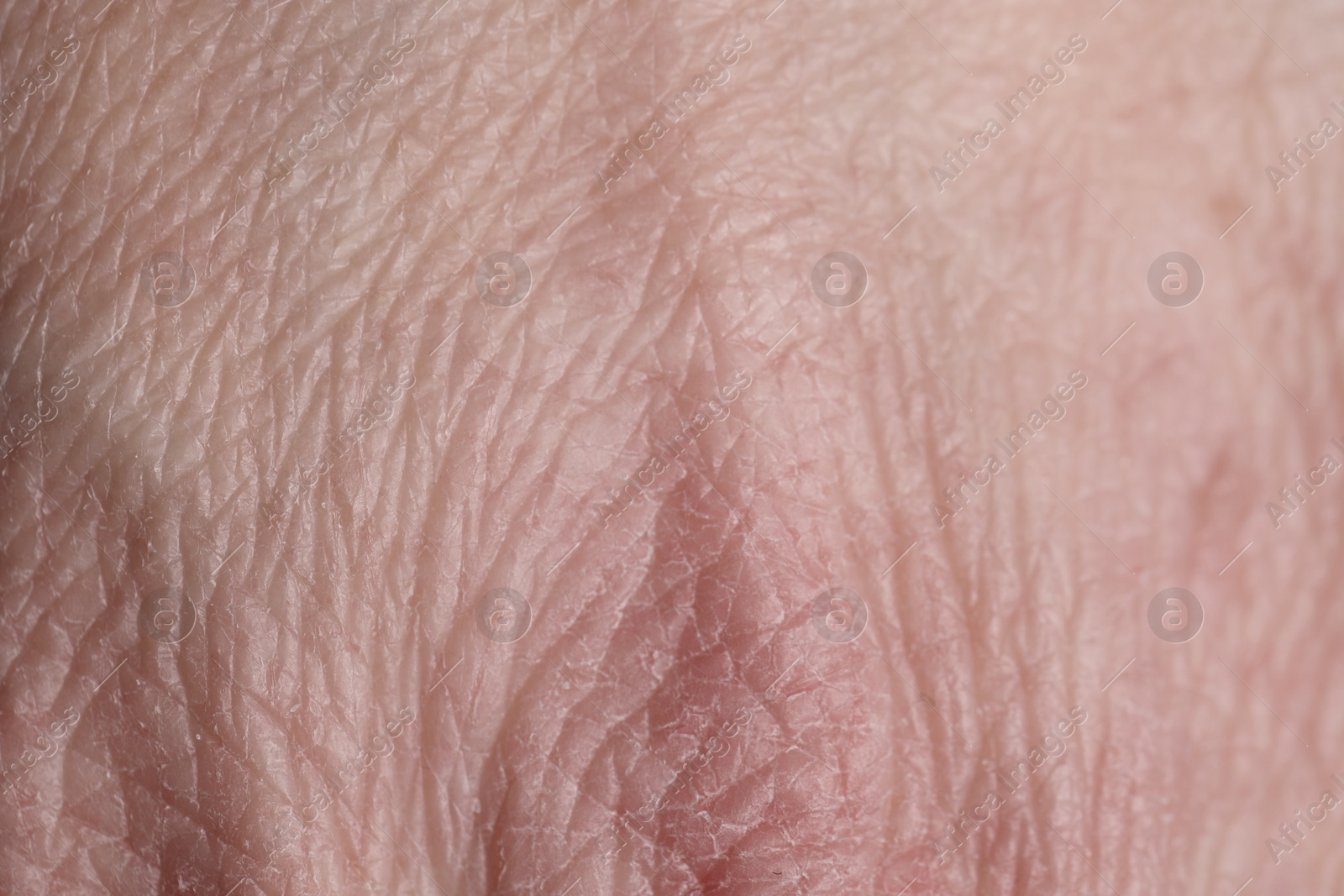 Photo of Texture of dry skin as background, closeup