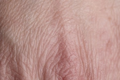 Photo of Texture of dry skin as background, closeup