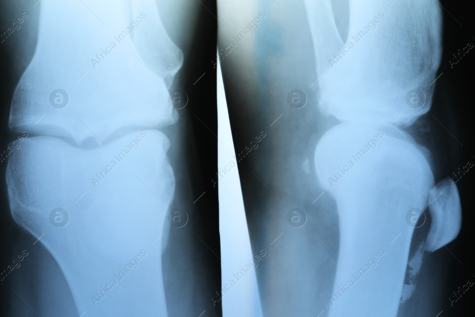 Photo of X-ray image of knee joint as background, closeup