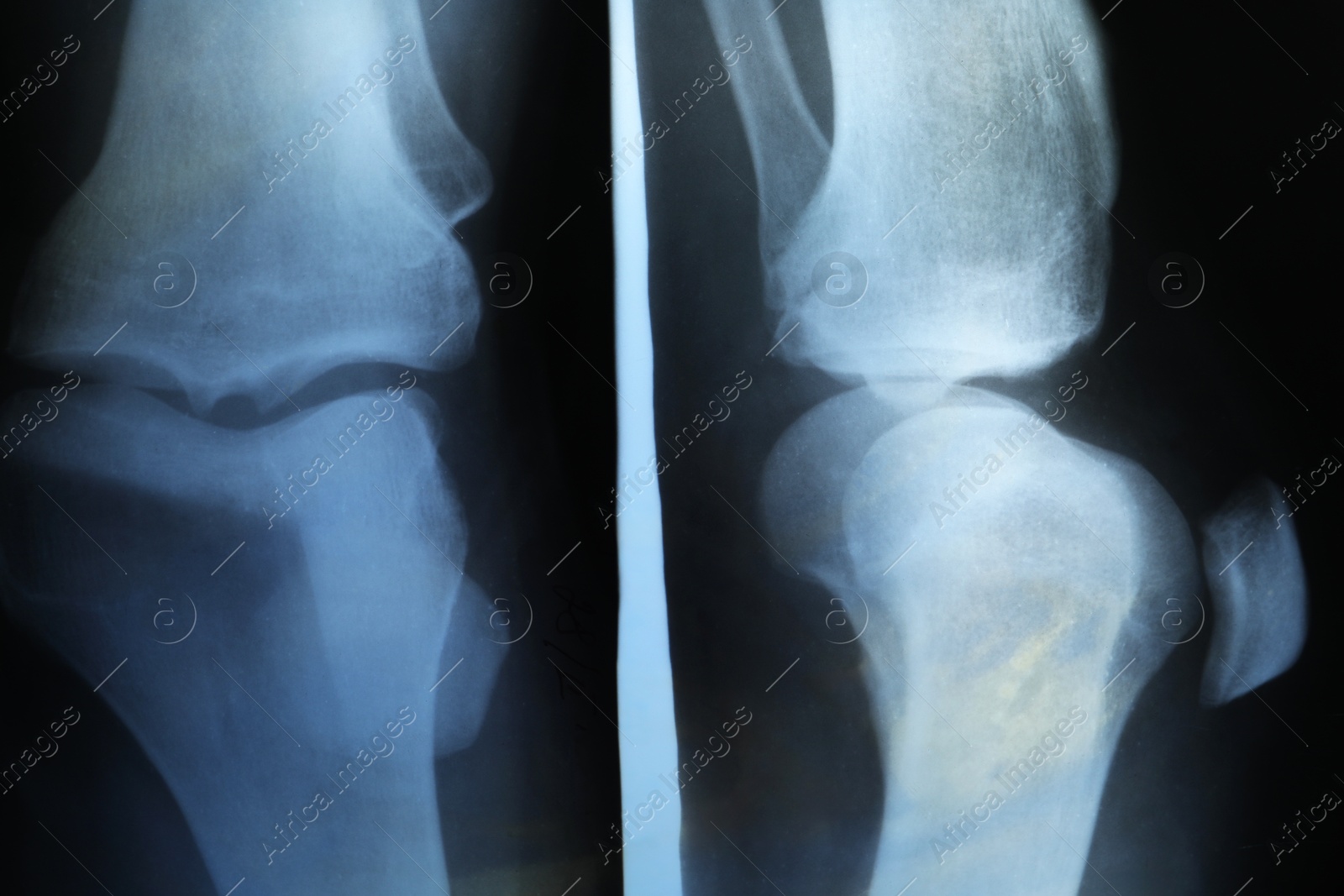 Photo of X-ray image of knee joint as background, closeup