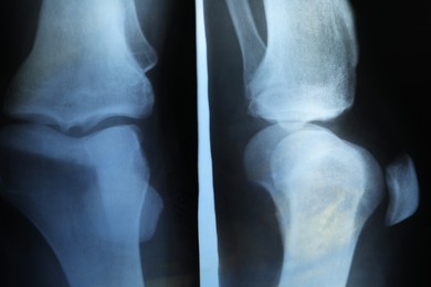 Photo of X-ray image of knee joint as background, closeup