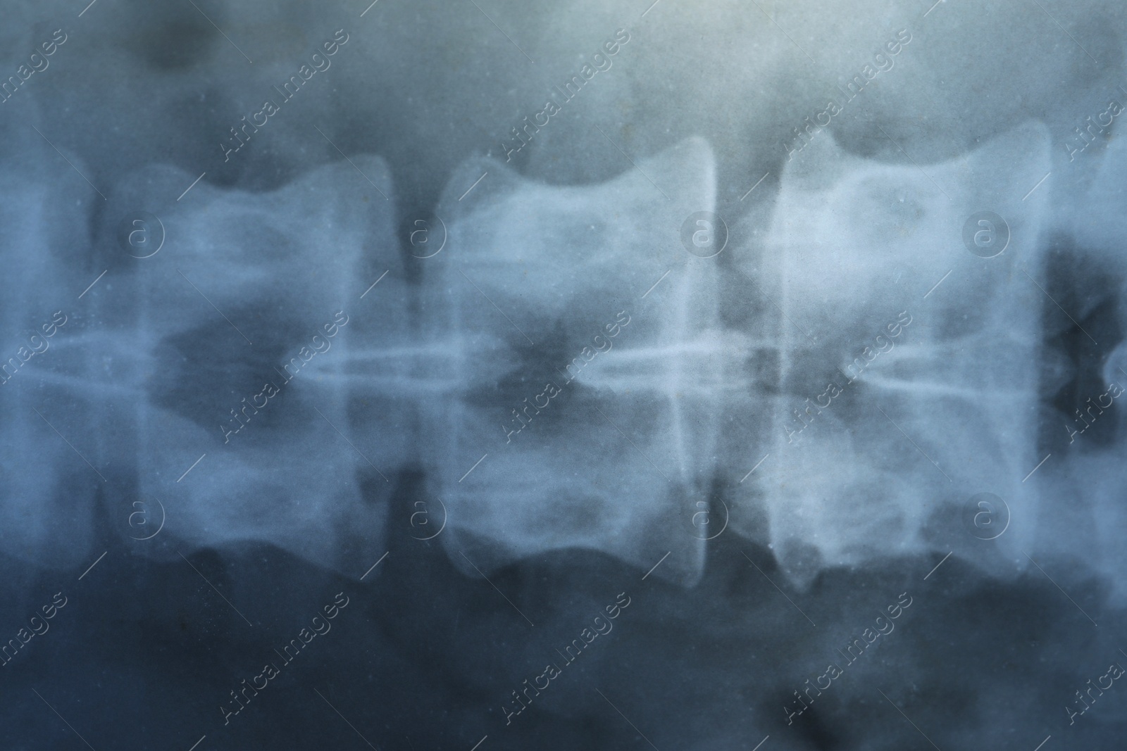 Photo of X-ray image of spinal column as background, closeup